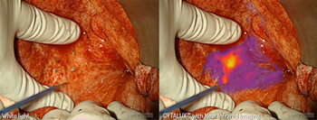 glowing tumor